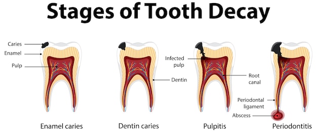 Infografik des menschen in den stadien der karies