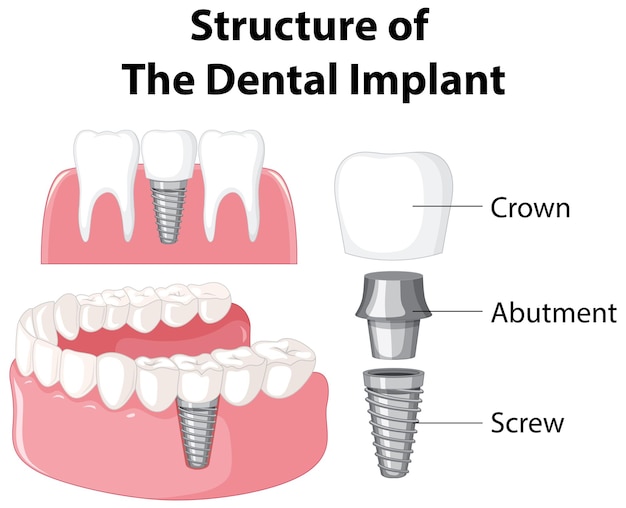 Infografik des Menschen in der Struktur des Zahnimplantats