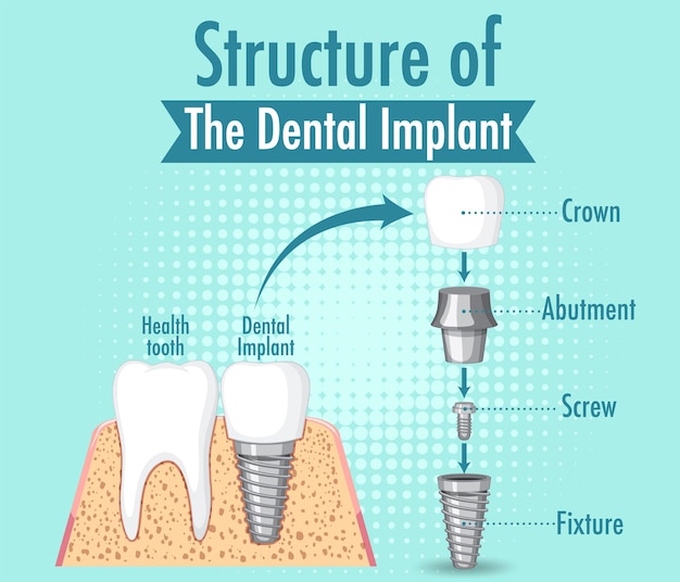 Kostenloser Vektor infografik des menschen in der struktur des zahnimplantats