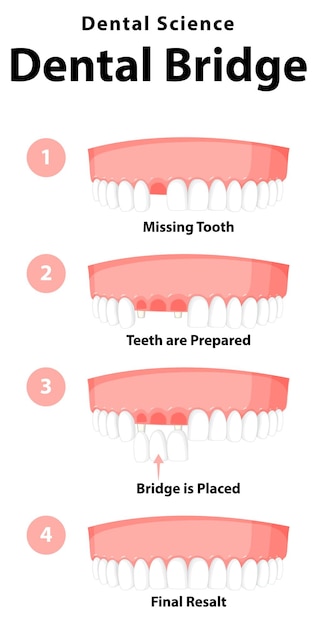 Kostenloser Vektor infografik des menschen in der zahnbrücke auf weißem hintergrund