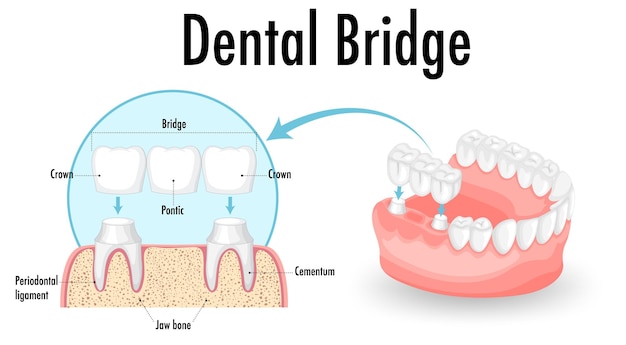 Infografik des Menschen in der Zahnbrücke auf weißem Hintergrund