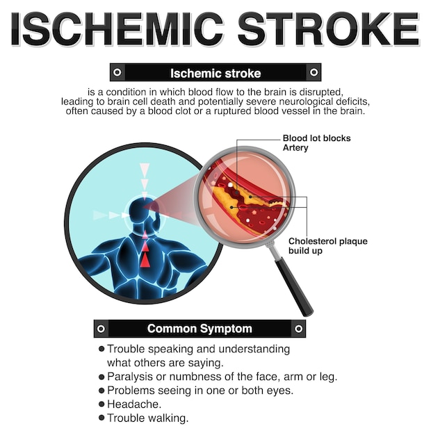 Kostenloser Vektor informatives poster zum thema ischämischer schlaganfall