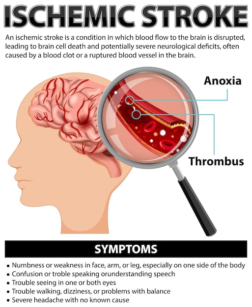 Kostenloser Vektor informatives poster zum thema ischämischer schlaganfall