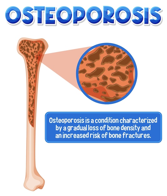 Informatives poster zum thema osteoporose menschlicher knochen