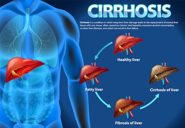 Informatives poster zur alkoholischen lebererkrankung zirrhose