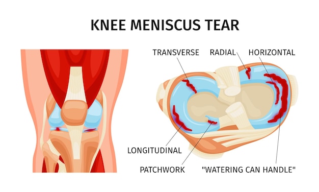 Kniemeniskusriss anatomiediagramm realistische infografiken auf weißer hintergrundvektorillustration