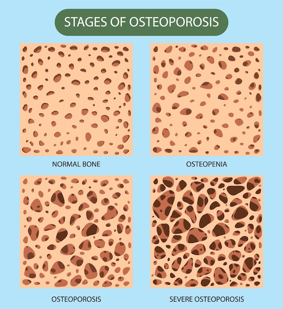 Knochendichte und osteoporose-vektor