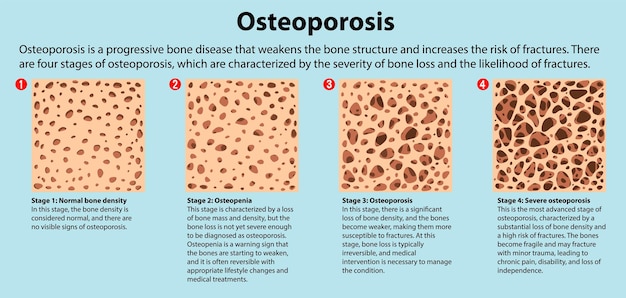 Kostenloser Vektor knochendichte und osteoporose-vektor