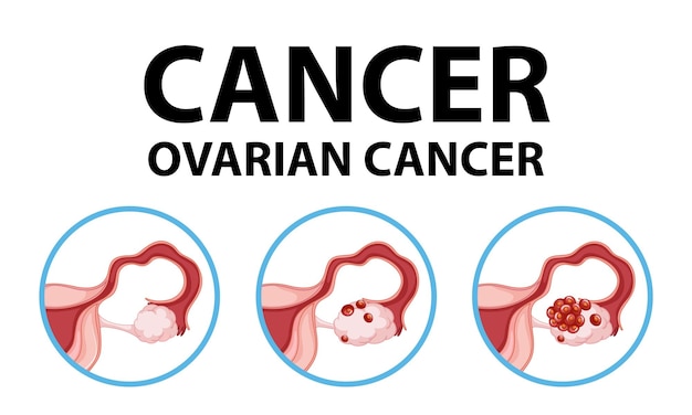 Medizinische anatomie-infografik woman39s eierstockkrebs-bewusstsein