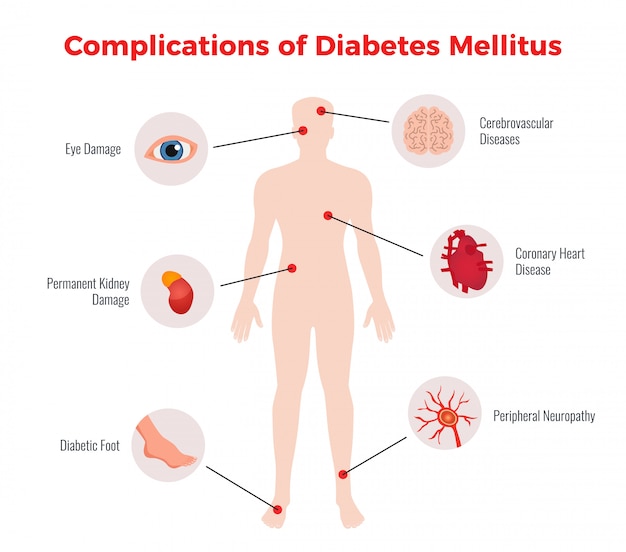 Medizinische aufklärungskarte für diabetes-komplikationen mit darstellung und beschreibung der schäden an betroffenen menschlichen organen flach