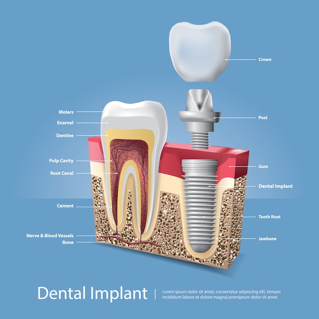 Kostenloser Vektor menschliche zähne und zahnimplantat-vektor-illustration