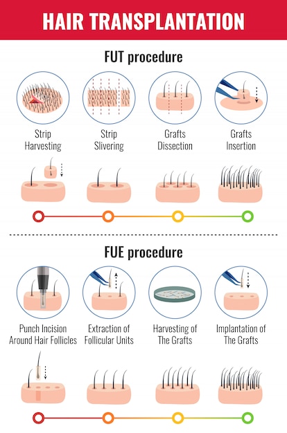 Kostenloser Vektor methoden der haartransplantation mit infografiken im stadium des verfahrens auf weiß