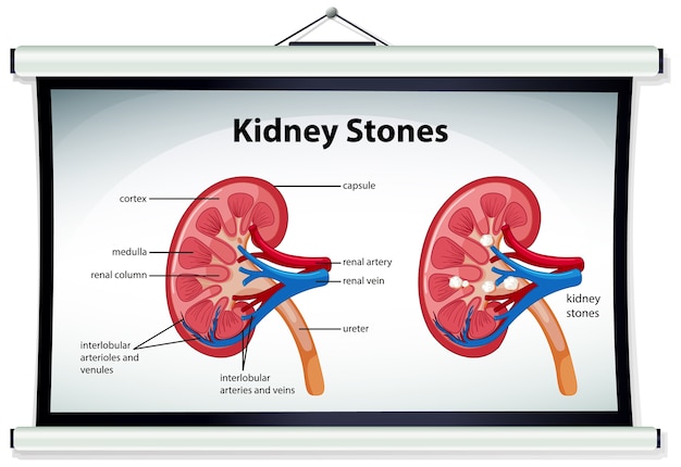 Nierenstein symptome symptome cartoon-stil infografik