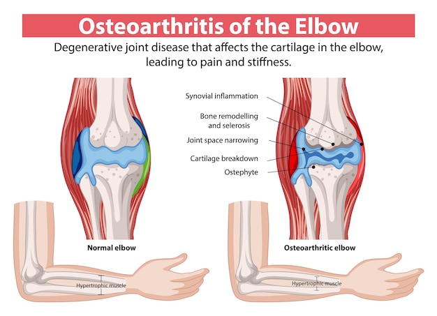 Kostenloser Vektor osteoarthritis der ellbogen