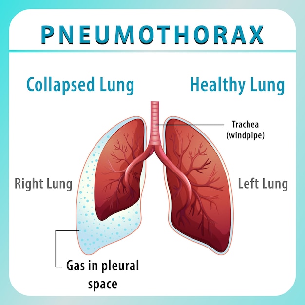 Kostenloser Vektor pneumothorax-diagramm mit kollabierter lunge und gesunder lunge