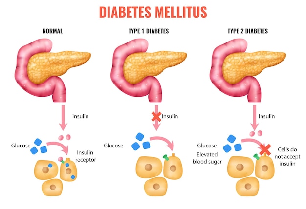 Kostenloser Vektor realistische bauchspeicheldrüsenanatomie-insulin-diabetes-mellitus-infografiken mit notmaler und beschädigter bauchspeicheldrüse mit bearbeitbaren textunterschriften, vektorgrafik