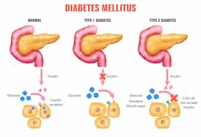 Kostenloser Vektor realistische bauchspeicheldrüsenanatomie-insulin-diabetes-mellitus-infografiken mit notmaler und beschädigter bauchspeicheldrüse mit bearbeitbaren textunterschriften, vektorgrafik