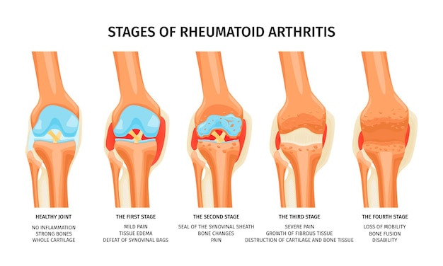 Realistische infografiken, die vier stadien der rheumatoiden arthritis der kniegelenkvektorillustration zeigen