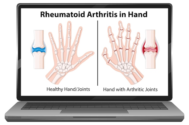 Kostenloser Vektor rheumatoide arthritis-symptome auf dem laptop-bildschirm vorhanden