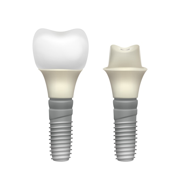 Kostenloser Vektor seitenansicht des zusammengesetzten zahnimplantats des vektorkunststoffs lokalisiert auf weißem hintergrund