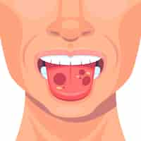 Kostenloser Vektor stomatitis-illustration im flachen design