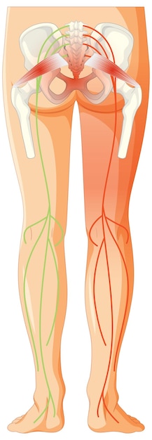 Kostenloser Vektor unterer rücken, der an ankylosierender spondylitis leidet