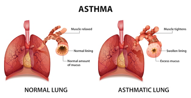 Kostenloser Vektor vergleich von gesunder lunge und asthmatischer lunge