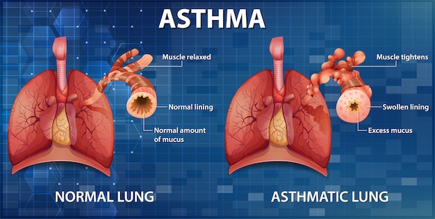 Vergleich von gesunder lunge und asthmatischer lunge