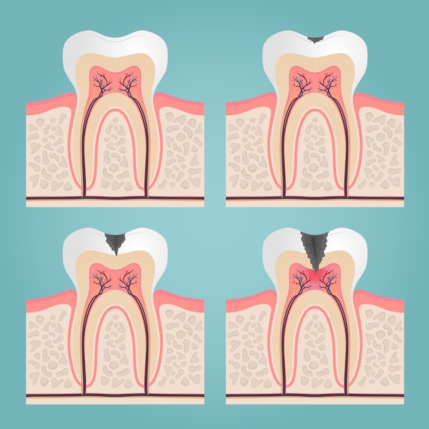 Zahnanatomie und beschädigung, geschnittene zähne in der zahnfleischvektorillustration