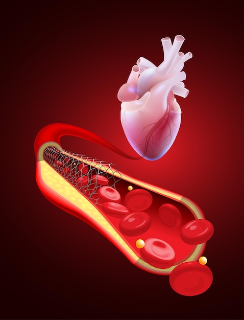 3D-Darstellung einer menschlichen Koronararterie mit normalem Blutfluss nach einer Angioplastie mit einem Stent