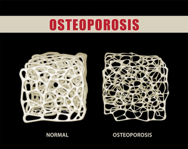 Vektor 3d-darstellung zum vergleich von osteoporose mit normalem knochen auf schwarzem hintergrund. medizinische verwendung bildung a