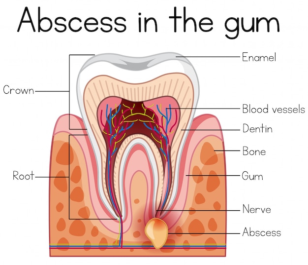 Vektor abszess im gum-diagramm