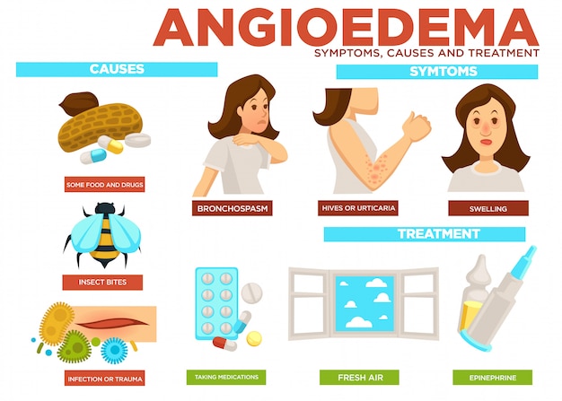 Angioödem symptom, ursachen und behandlung von krankheiten