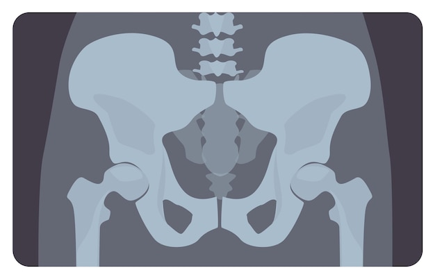 Anteriore röntgenaufnahme des menschlichen beckens oder hüftknochens mit lendenwirbelbereich. röntgenbild oder bild des menschlichen skelettsystems, vorderansicht. erkennung von medizinischen krankheiten. vektorillustration im flachen cartoon-stil