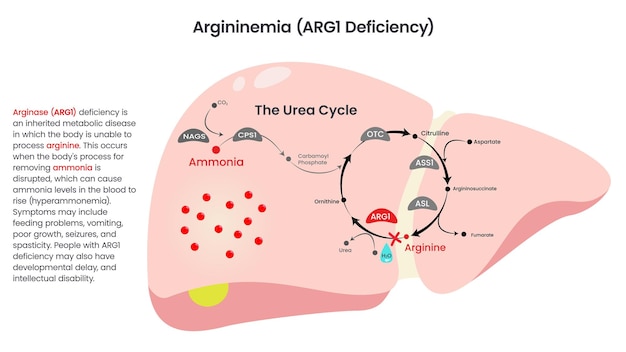 Arginase arg1-mangel-vektordiagramm-darstellung