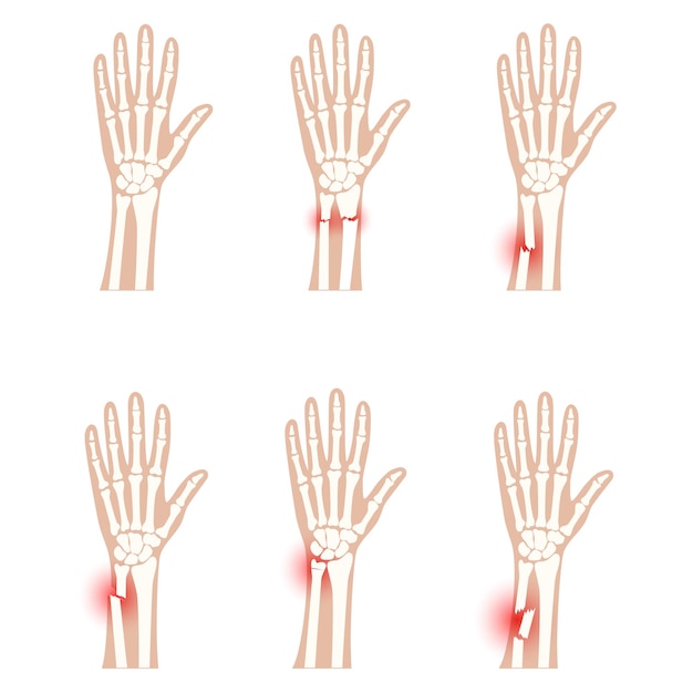 Arten von Frakturen und normaler Arm. Inneres geschlossenes und offenes Trauma. Greenstick, distal und zerkleinert