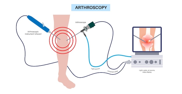 Arthroskopie des kniegelenks
