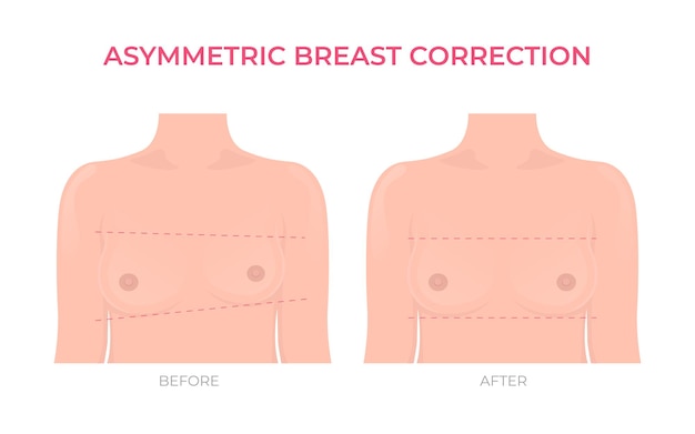 Asymmetrische Brustkorrektur vor und nach plastischer Chirurgie Vorderansicht