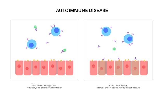 Vektor autoimmunhepatitis