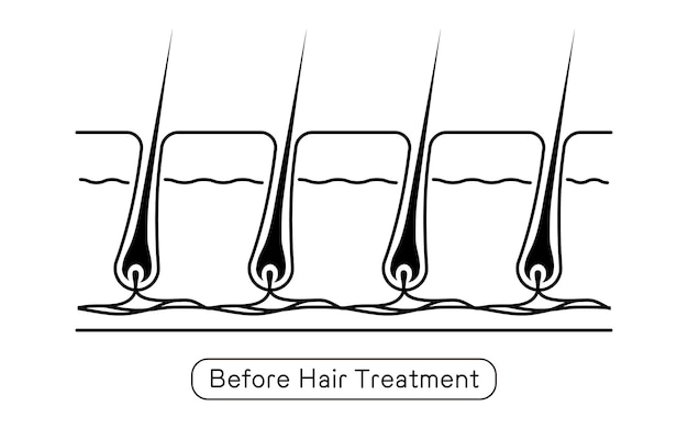 Vektor bild der haarentfernung vor und unbehandeltem haar