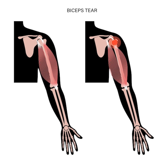 Vektor bizepsrisstrauma