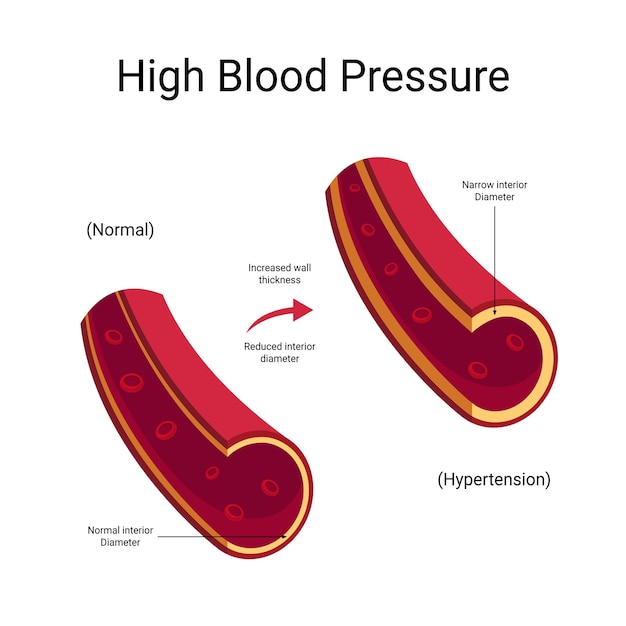 Vektor bluthochdruck-vektor-illustration hypertonie-infografik