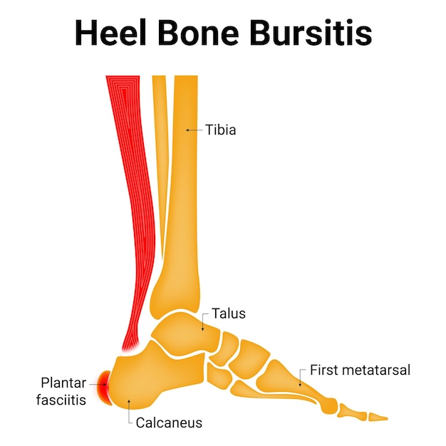 Vektor bursitis der fersenknochen tibia talus erster metatarsal plantar fasziitis kalkaneus vektor illustration