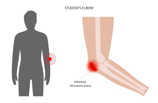 Bursitis des studentischen ellbogens