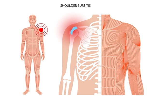 Bursitis-entzündungskonzept