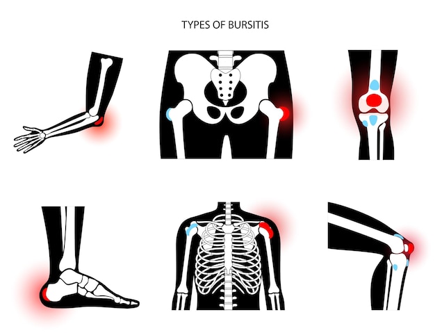 Bursitis-symbole gesetzt