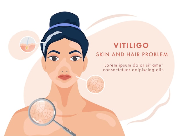 Charakter der jungen Frau, die Vitiligo Haut- und Haarproblem zeigt