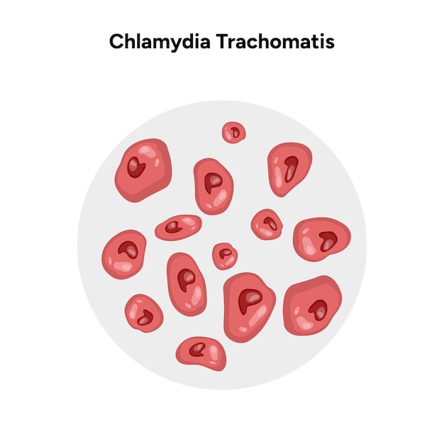 Chlamydia Trachomatis Infektionen des Fortpflanzungsapparates von Frauen und Männern Medizinische Erkrankung