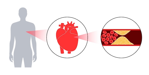 Cholesterin-herzkrankheit