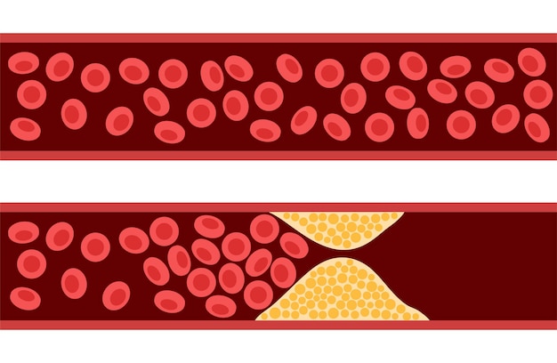 Vektor cholesterin und arteriosklerose